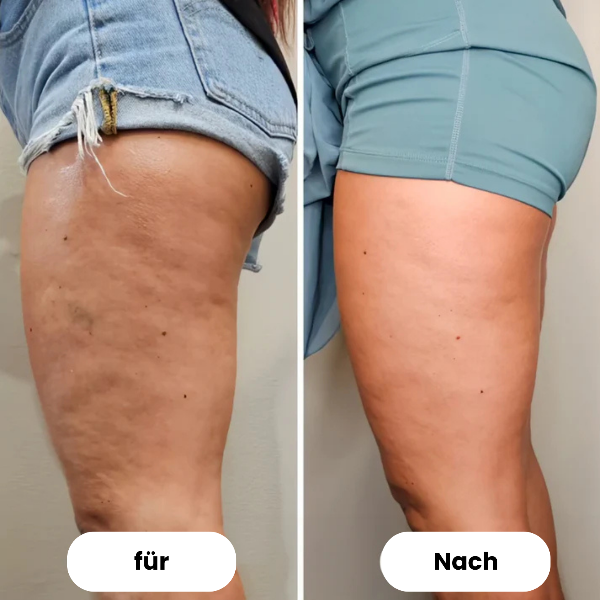 Elena™ | Anti-Cellulite Massagegerät für straffe Haut